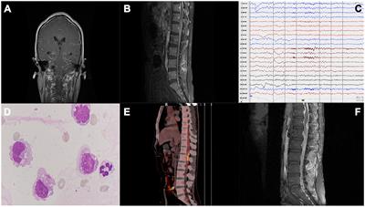 Adult spinal cord diffuse midline glioma, H3 K27-altered mimics symptoms of central nervous system infection: a case report